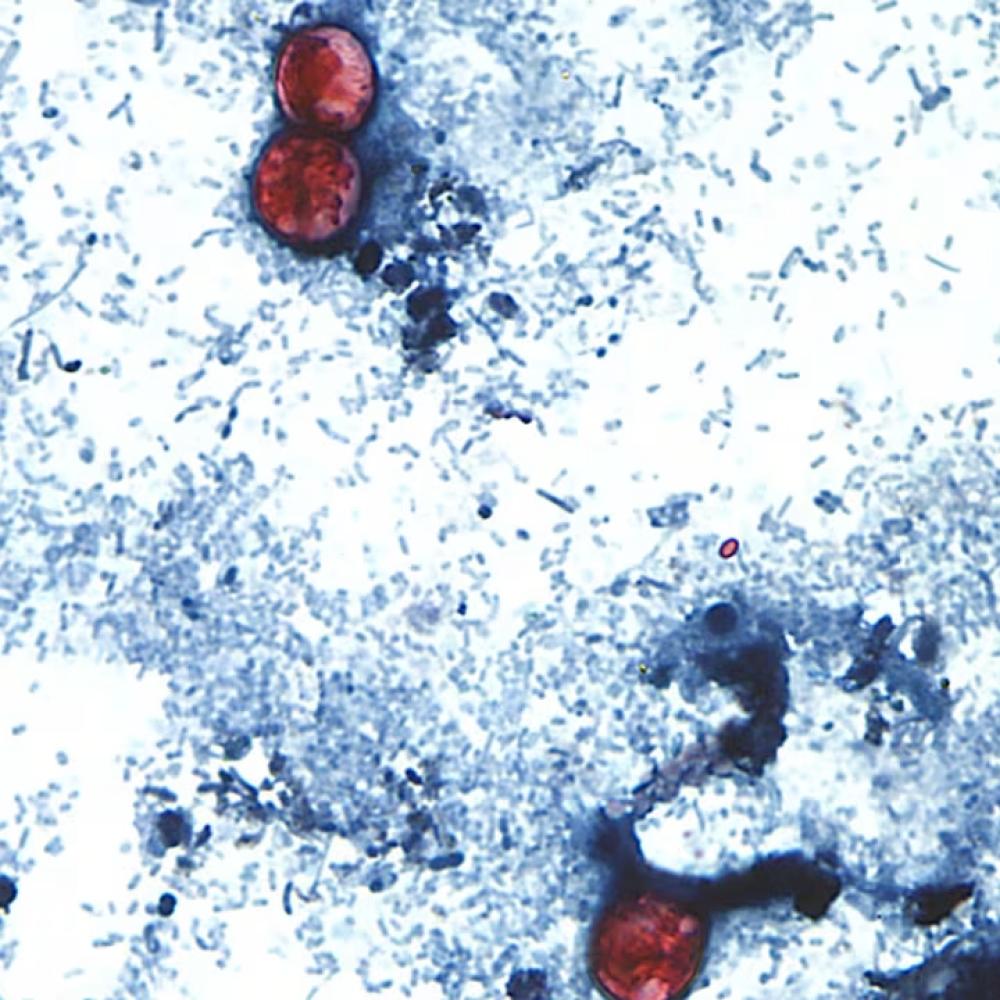 A diarrhea-causing parasite has infected more than 1,000 in the U.S. Is it in Canada?