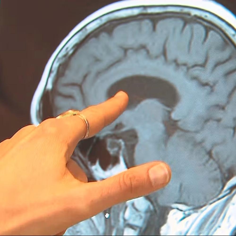 Up to 45% of dementia risk can be prevented, delayed: WHO