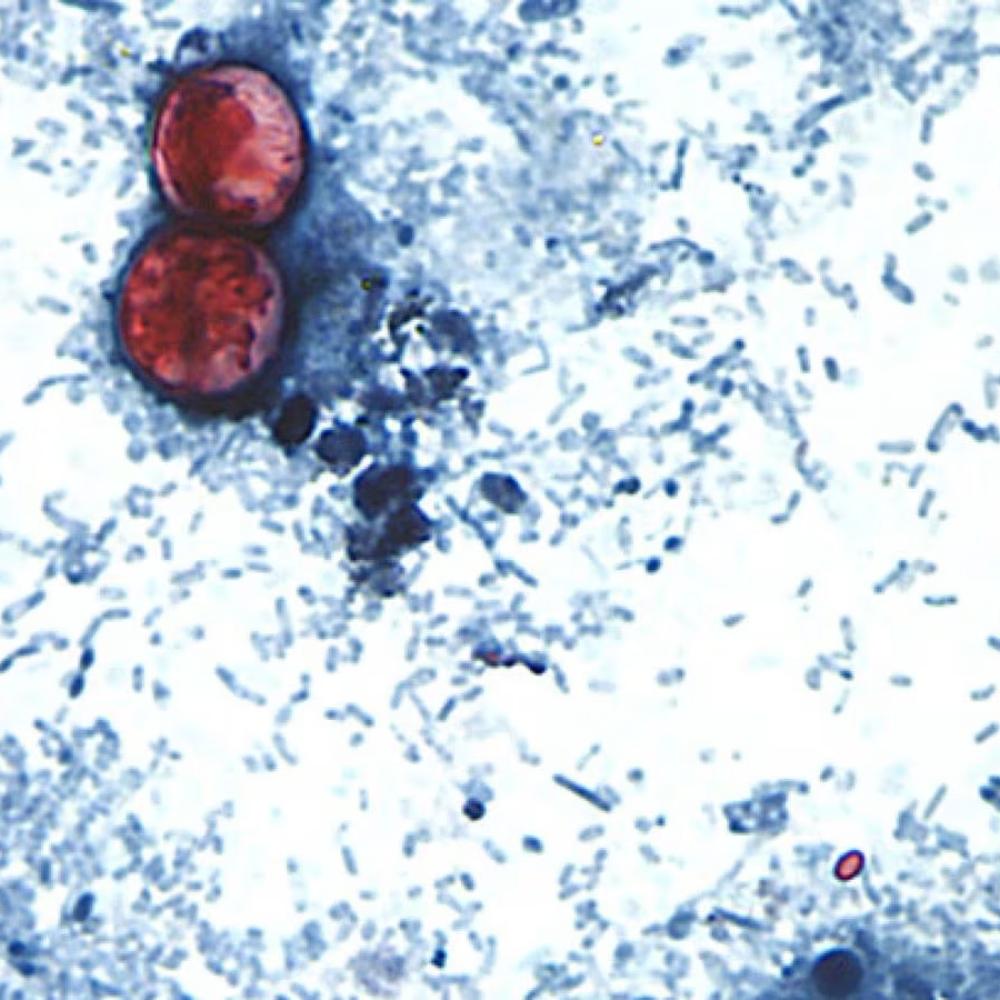 First deaths reported in cyclosporiasis outbreak