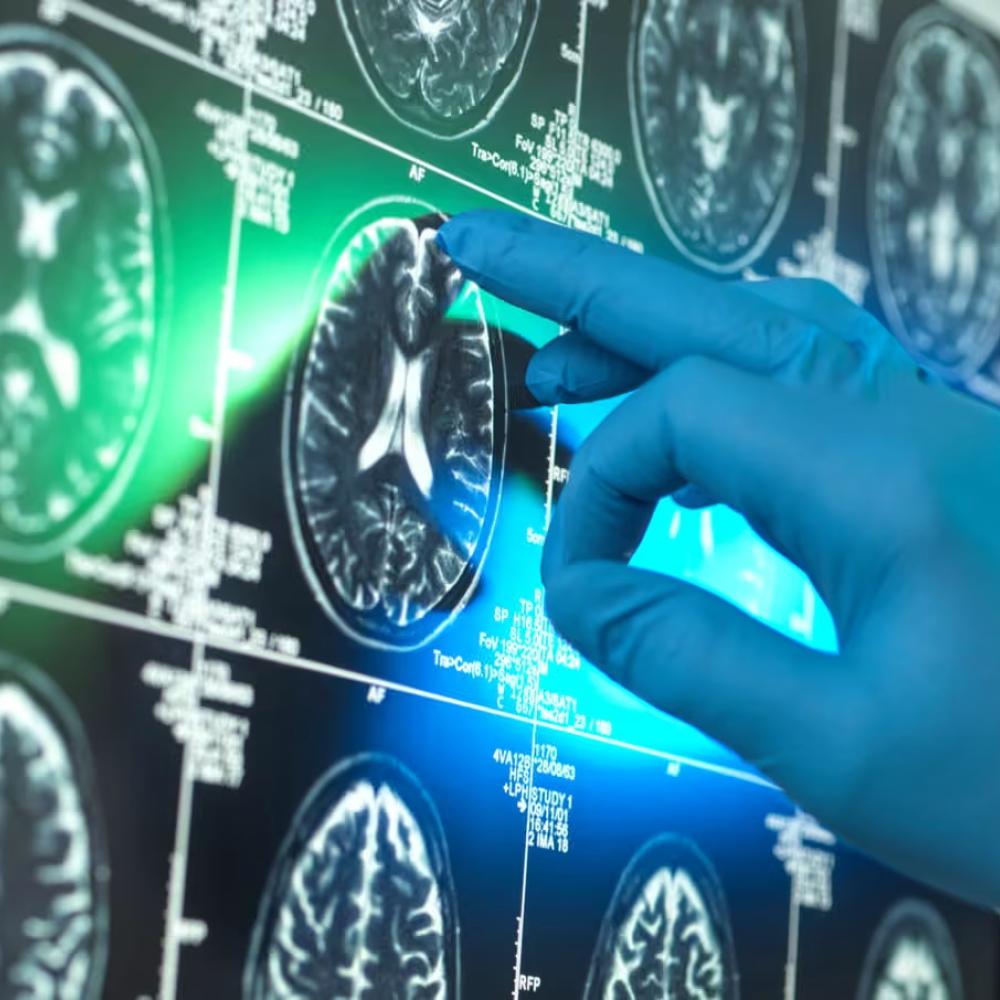 Alzheimer’s research is latest casualty in Trump administration war against ‘DEI’
