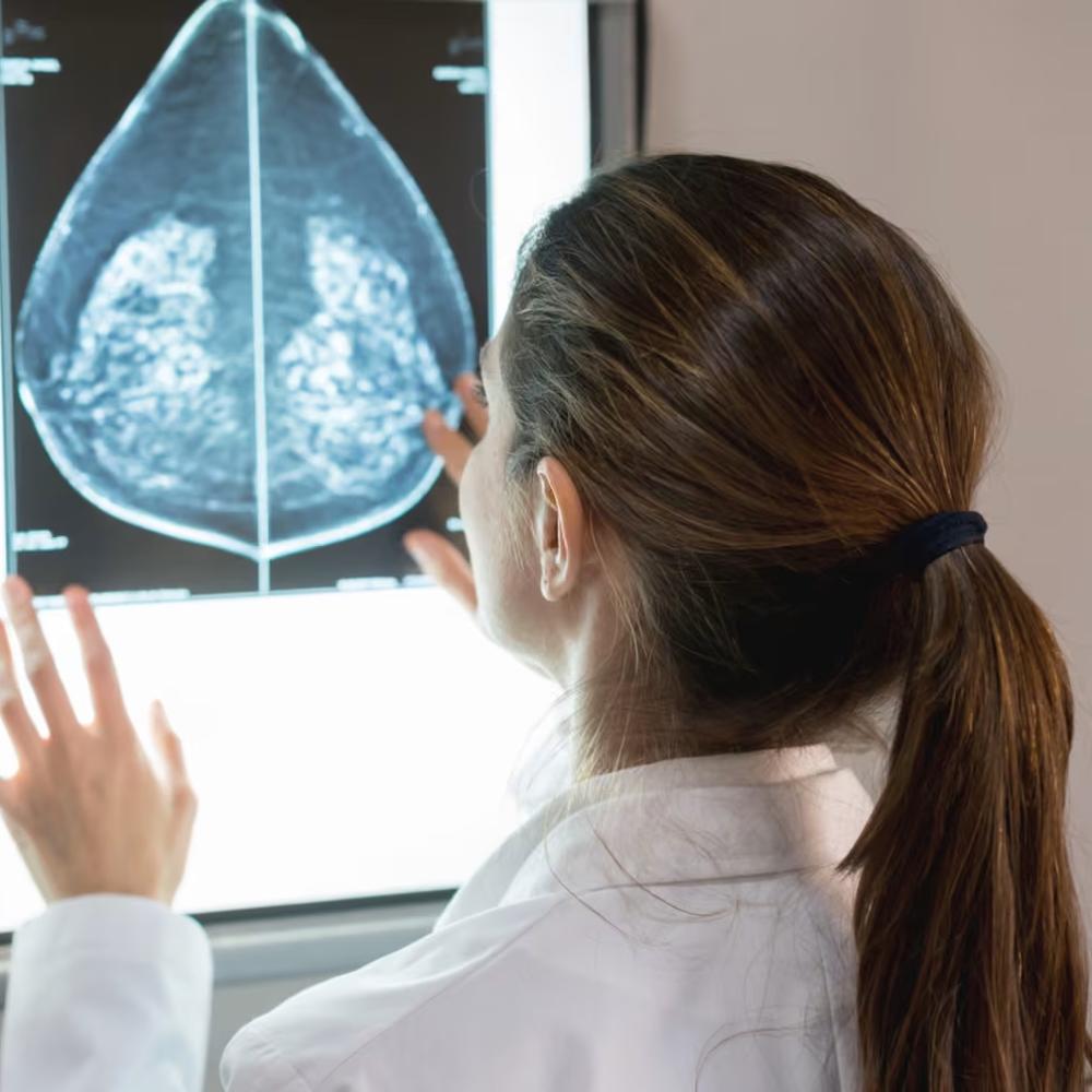 AI can detect heart disease in women using mammograms, study suggests