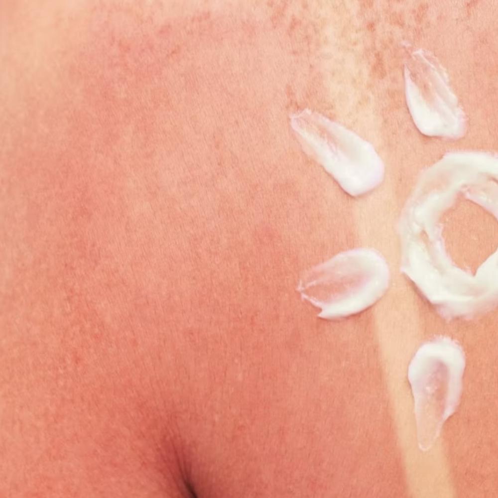 No safe tan: Why Canada’s sunburn problem keeps getting worse
