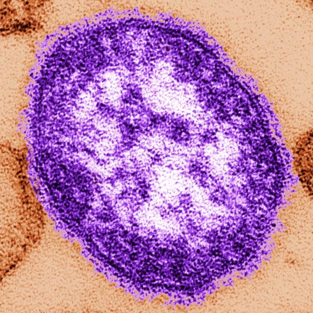 Pennsylvania says an unvaccinated woman has died from measles-related complications