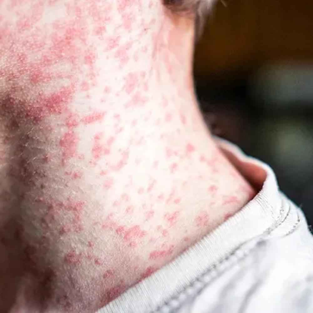 How Canada Can Prevent the Next Measles Outbreak