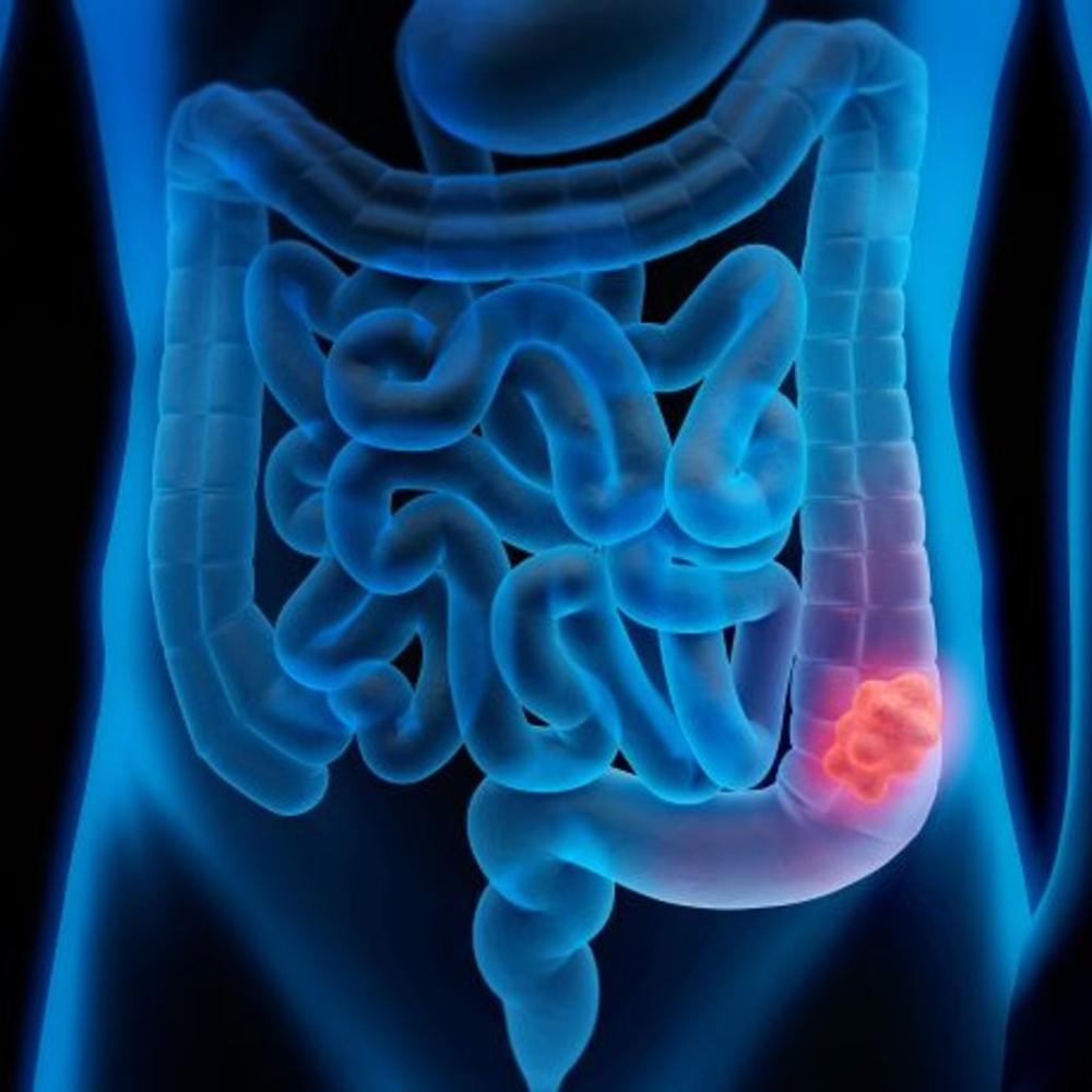 American Cancer Society recommends blood screening for colorectal cancer