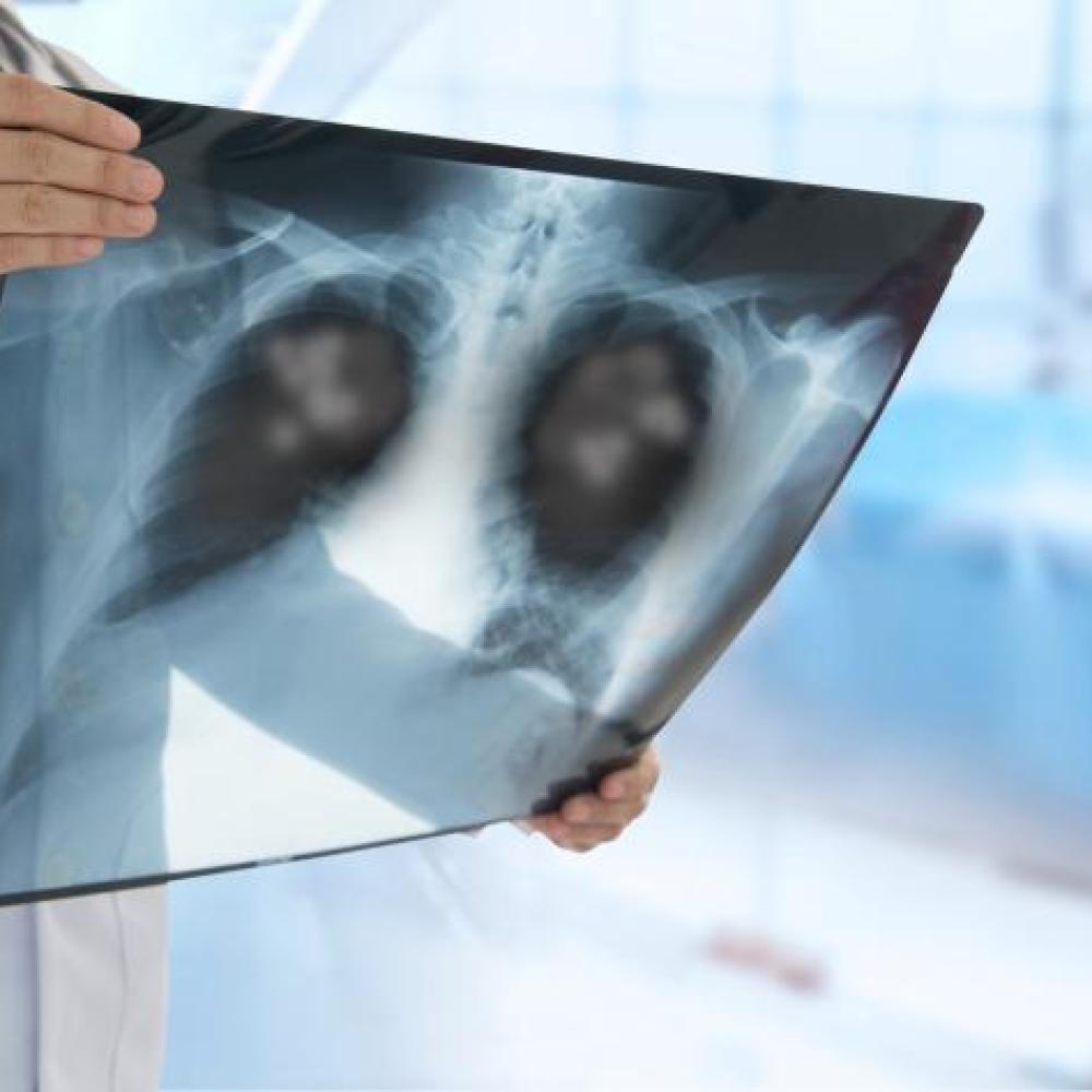 Antibiotic resistance threatens 30-year decline in deaths from lower respiratory infections