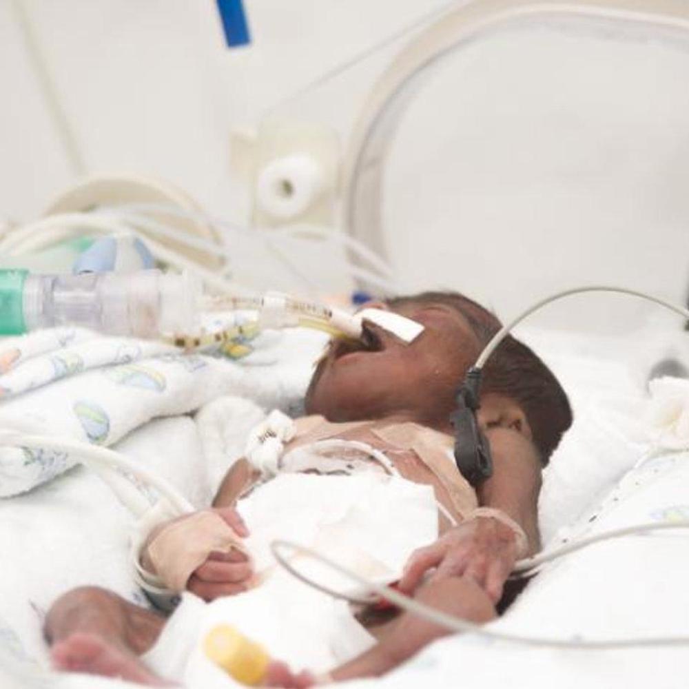 Babies with COVID-19 develop more serious disease than those with RSV, US data reveal