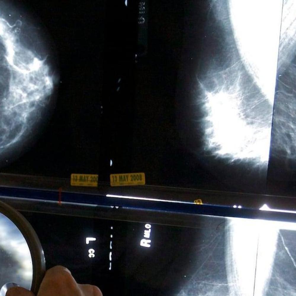 Black women face up to 70 per cent higher breast cancer mortality, study finds