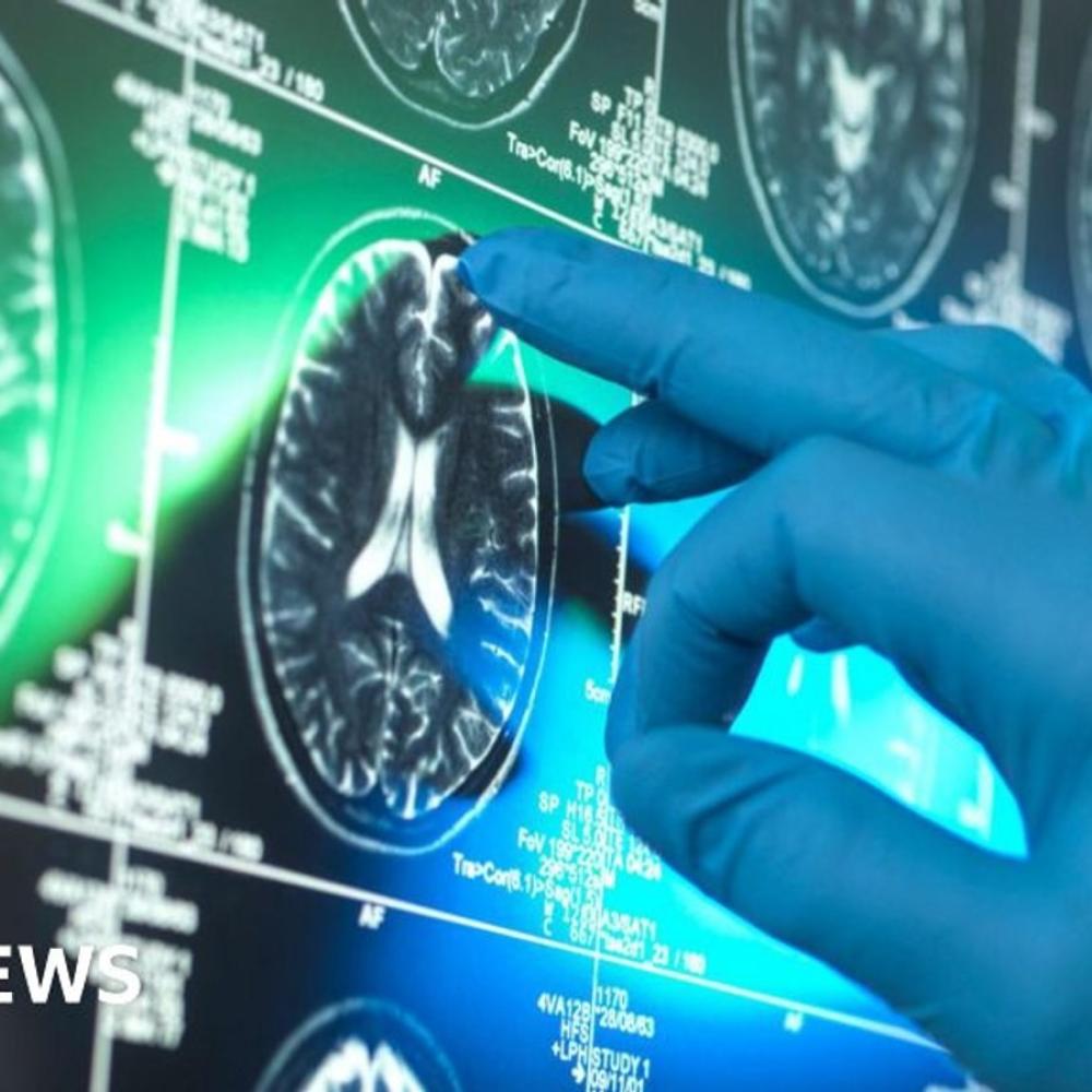 'Breakthrough' Alzheimer's drugs unlikely to benefit patients, report suggests