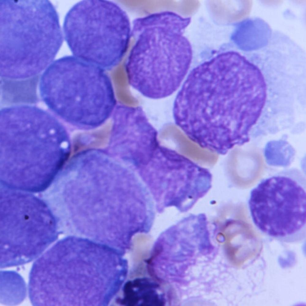 Genetic variant appears to protect against blood cancers