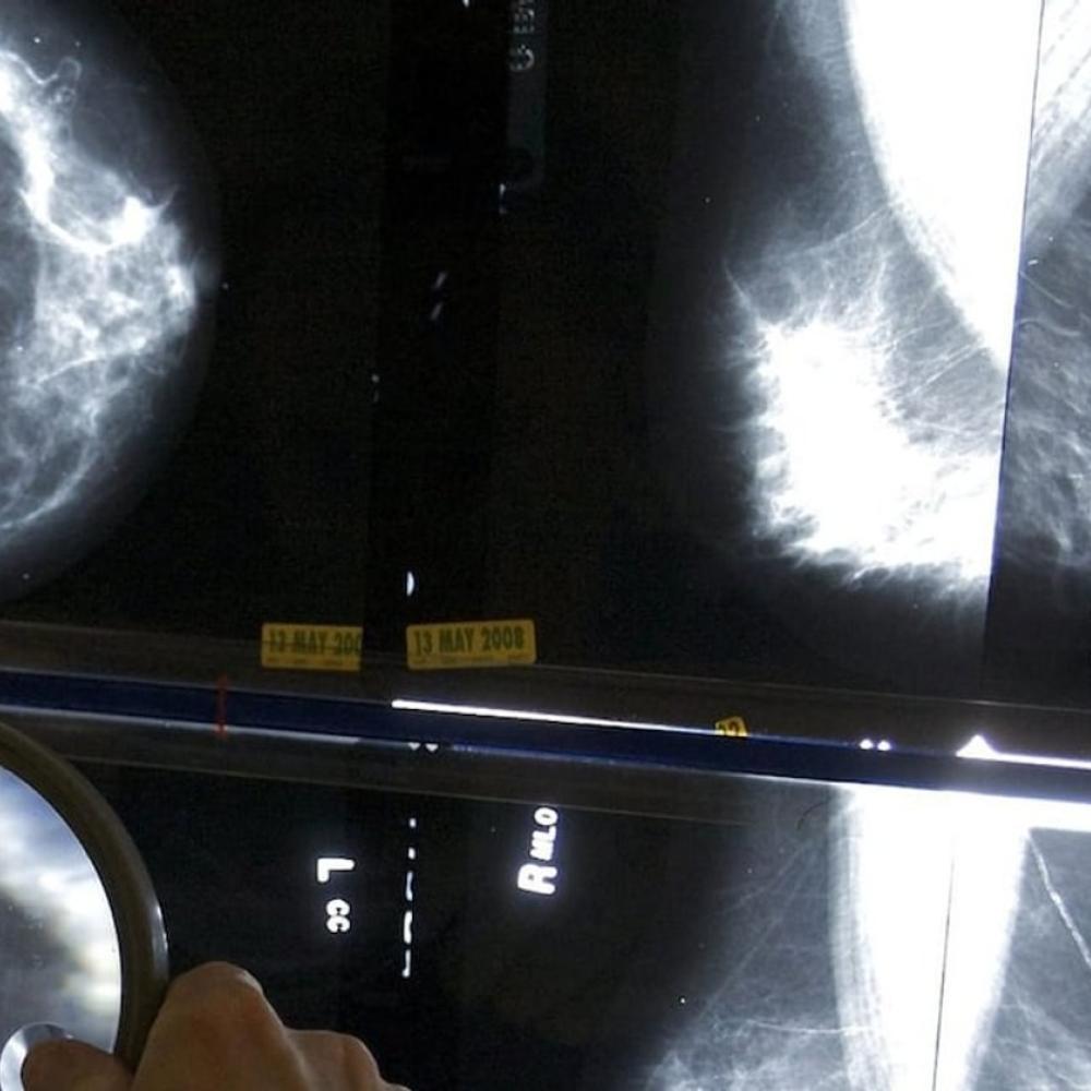 Global breast cancer cases expected to reach over 3.5 million by 2050