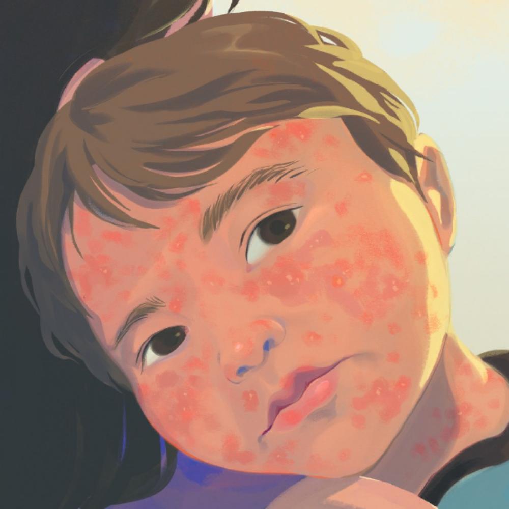 How Alberta Became the Epicentre of Canada's Measles Outbreak