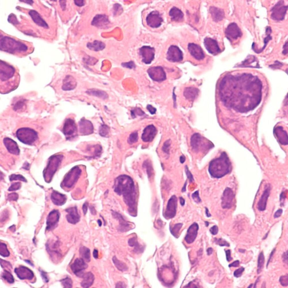 Lung cancer in 'never-smokers' draws new focus — and questions