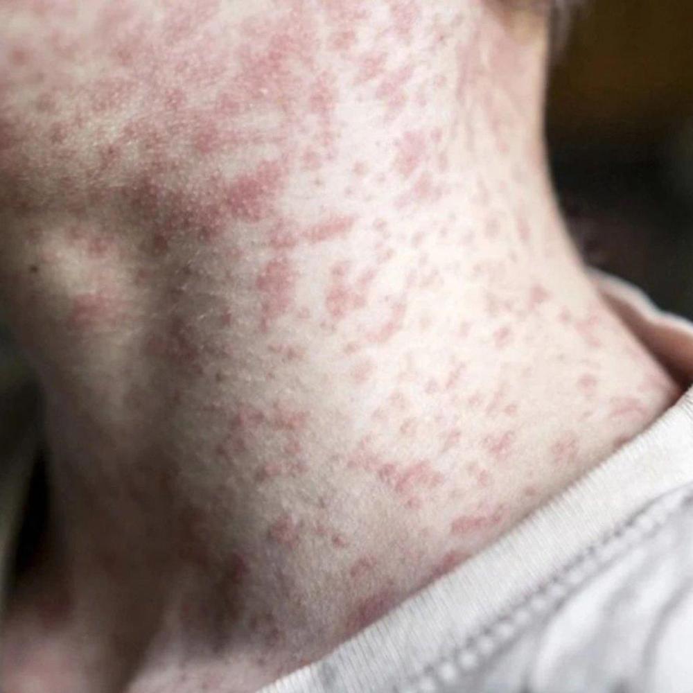 Measles exposure alert issued for Calgary airport, bus terminals around Alberta