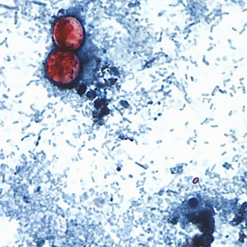 Michigan reports first U.S. deaths from multi-state cyclosporiasis outbreak