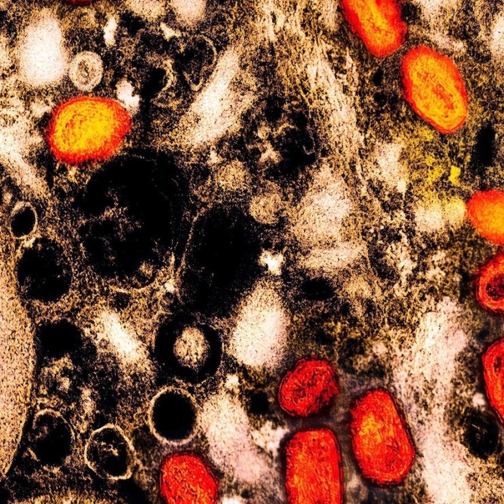 More than half of mpox patients in 2022 outbreak experienced lasting physical effects