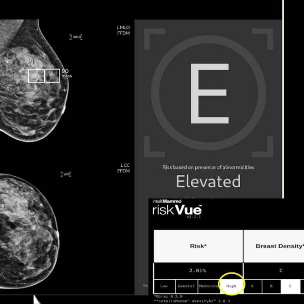 Radiologists catch more aggressive breast cancers by using AI to help read mammograms: study
