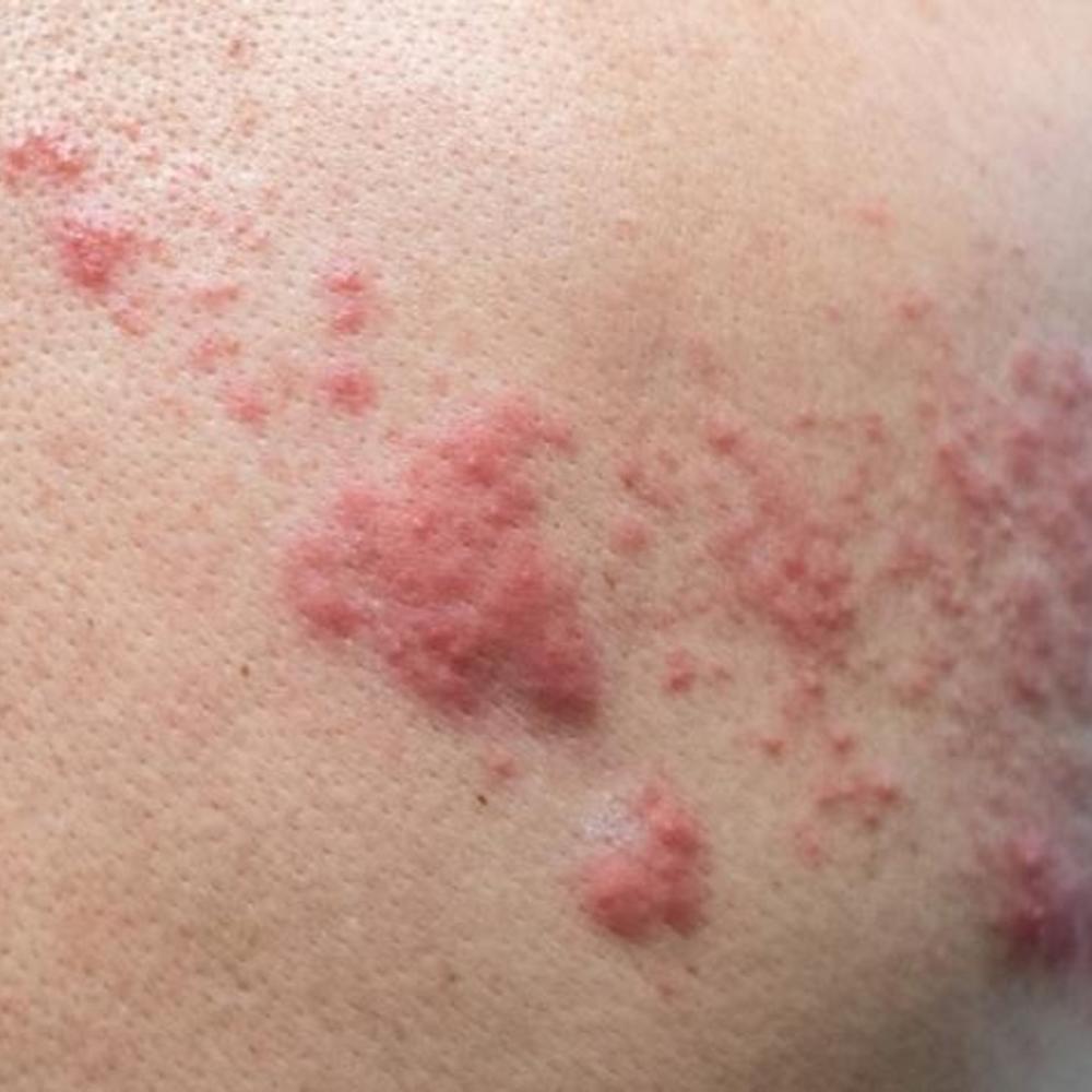 Study suggests elevated shingles risk in younger adults with chronic conditions