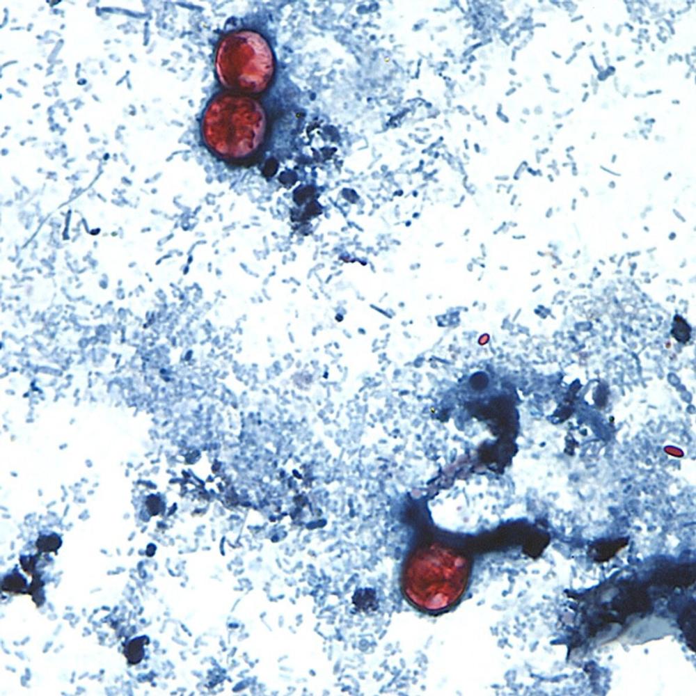 What to know about cyclosporiasis, the gastrointestinal illness outbreak hitting the U.S.