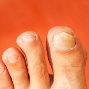 10K toenail clippings needed for Canadian study on potential lung cancer risk