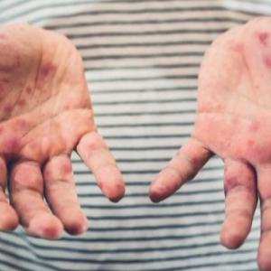 Alberta reports 17 more cases of measles, bringing total to more than 200