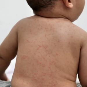 Measles cases show signs of exponential growth in western Canada