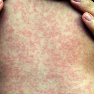 Measles 'out of control,' experts warn, as Alberta case counts surpass 1,000