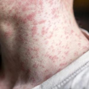 Smith must encourage measles vaccinations to fight outbreak