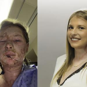 World-first burn treatment shows ‘remarkable’ results in Canadian patient