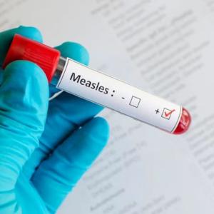 Members of the public may have been exposed to the measles at Pearson Airport, on 2 flights: health unit
