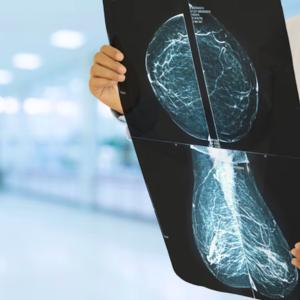 Canadian study suggests less breast cancer treatment may be just as effective, with fewer side-effects