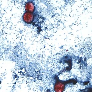 A diarrhea-causing parasite has infected more than 1,000 in the U.S. Is it in Canada?