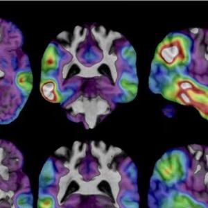 An experimental Alzheimer’s drug approved in U.S. shows some promise as researchers hunt new approaches