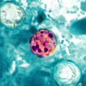Cyclospora outbreaks causing diarrhea in US expected to continue through August