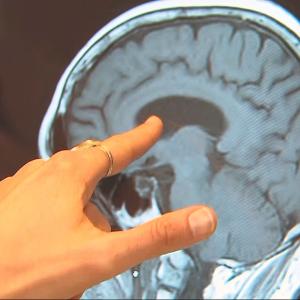 Up to 45% of dementia risk can be prevented, delayed: WHO