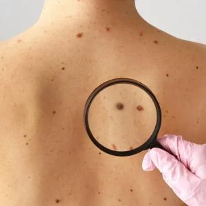 Experts urging people to use sunscreen as melanoma cases rise in Alberta
