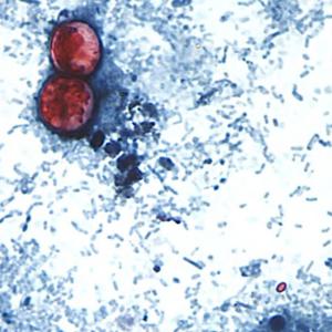 First deaths reported in cyclosporiasis outbreak