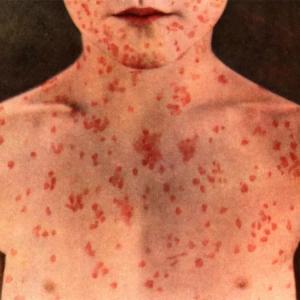 Canada’s measles cases are half of U.S. total, despite smaller population