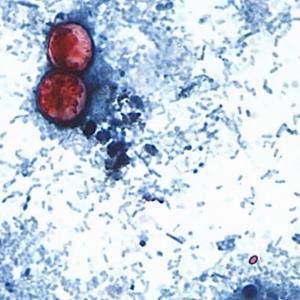 U.S. federal officials declare end to cyclospora outbreak that sickened thousands in 21 states