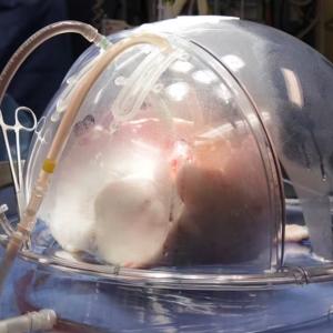 Toronto surgeon’s gene, stem cell therapy could make donor lungs ‘look more like itself’