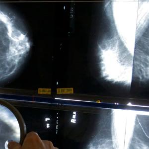Breast cancer screening needs to be more consistent, accessible