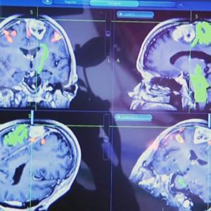 Chips, cereals and frozen meals could raise risk of brain damage and dementia, study finds