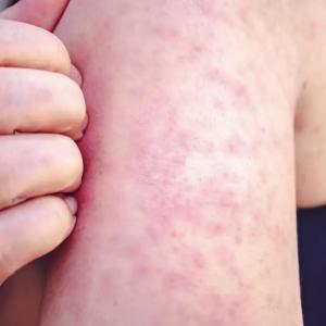 Canada’s 2-year measles outbreak officially over: PHAC