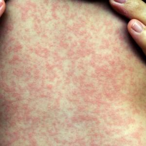 30 more measles cases confirmed in Manitoba, provincial health data shows