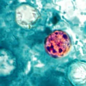 6 Albertans hit with parasitic illness, province says no link to U.S. outbreak found