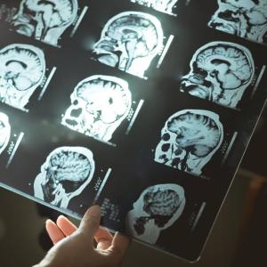 9 surprising habit changes that could prevent or delay dementia, according to Toronto experts