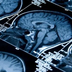 A new therapeutic approach developed by McMaster researchers could help prevent brain cancer. Here's how.