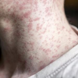 Alberta measles cases on the rise, as exposure at an Edmonton hospital prompts public alert