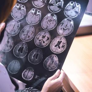 An approved new treatment slows the progress of Alzheimer's — but will provincial drug plans offer it?