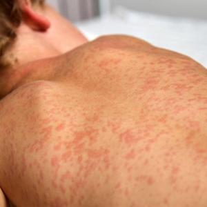 As Canada loses measles-free status, outbreak in northeast B.C. continues